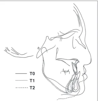 Fig. 1. The tracing of cephalogram in preoperative (T0), postopera- postopera-tive (T1), and debonding (T2) stage.