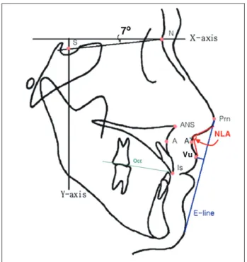 Fig. 2. Cephalometric landmarks and reference lines. S, sella: the  estimated center of the bony contour of the preoperative sella turcica; 