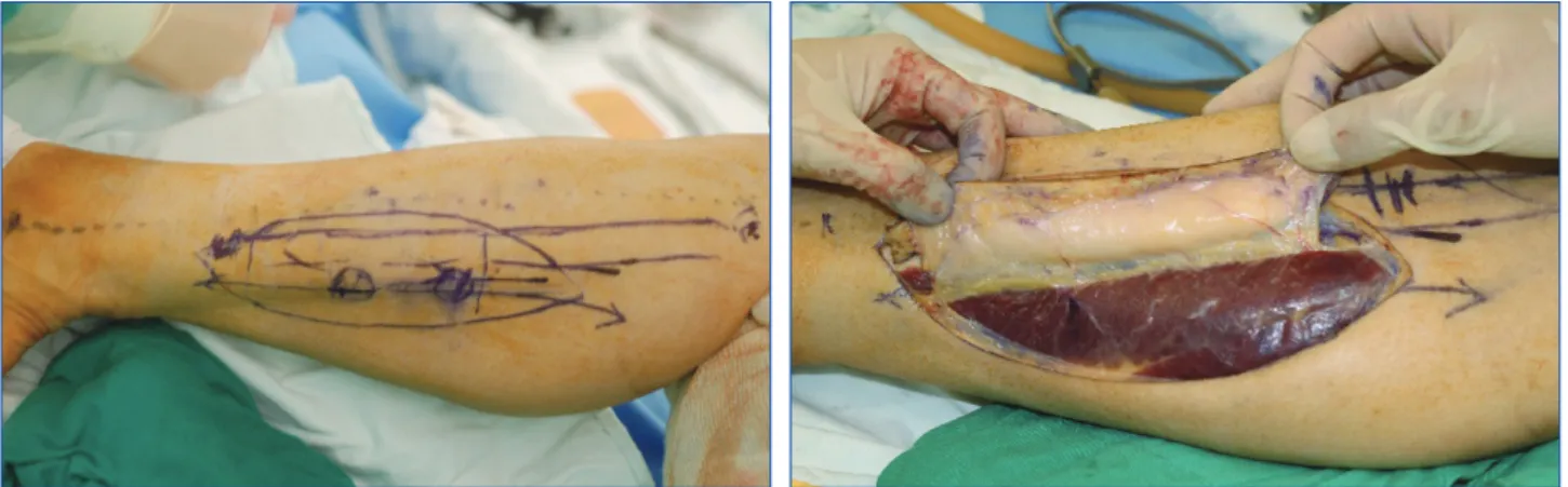 Fig. 1. (Left) CT angiography of the patient 2. (Right) The part indi- indi-cated with red box is zoomed
