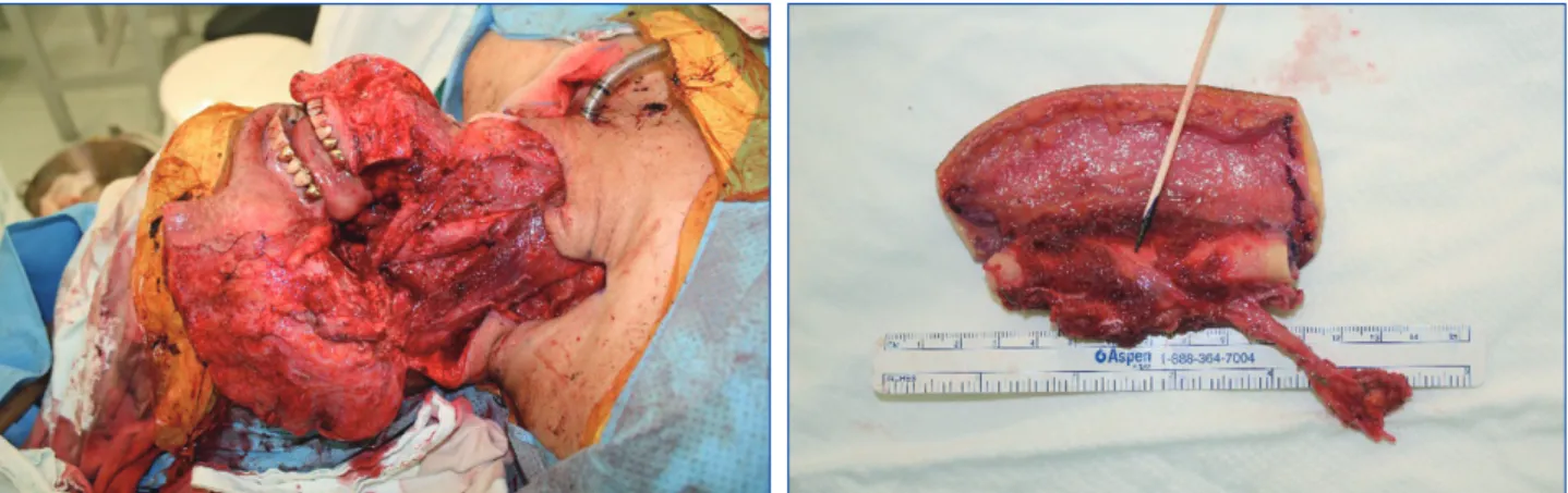 Fig. 3. (Left) Right mandibular segment was resected with the tumor including buccal mucosa and gingival