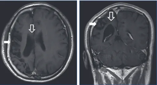 Fig. 1. A 45-year-old man showing depression of right forehead and scalp.