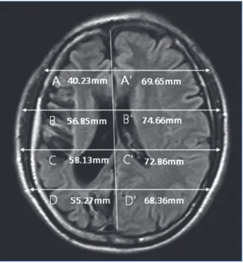 Fig. 3. Computed tomography shows a hyperpneumatization of the  mastoid cells (arrow).