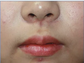 Fig. 4. Postoperative view 1 year after the complete excision was performed.