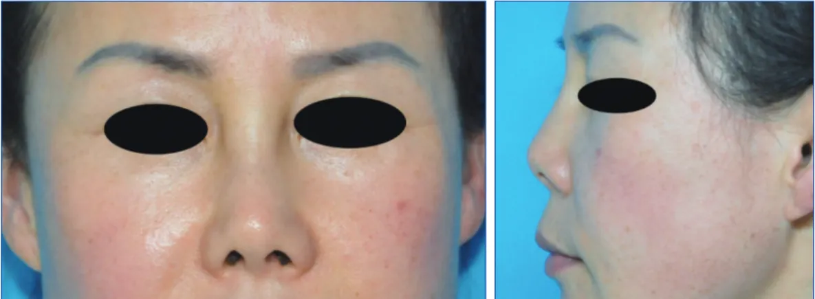 Fig. 1. A 42-year-old female with a painless, solid and irregular mass on nasal dorsum
