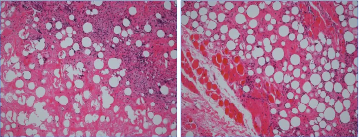 Fig. 3. Intraoperative view of the removed lipogranuloma showing  multiple irregular shape.