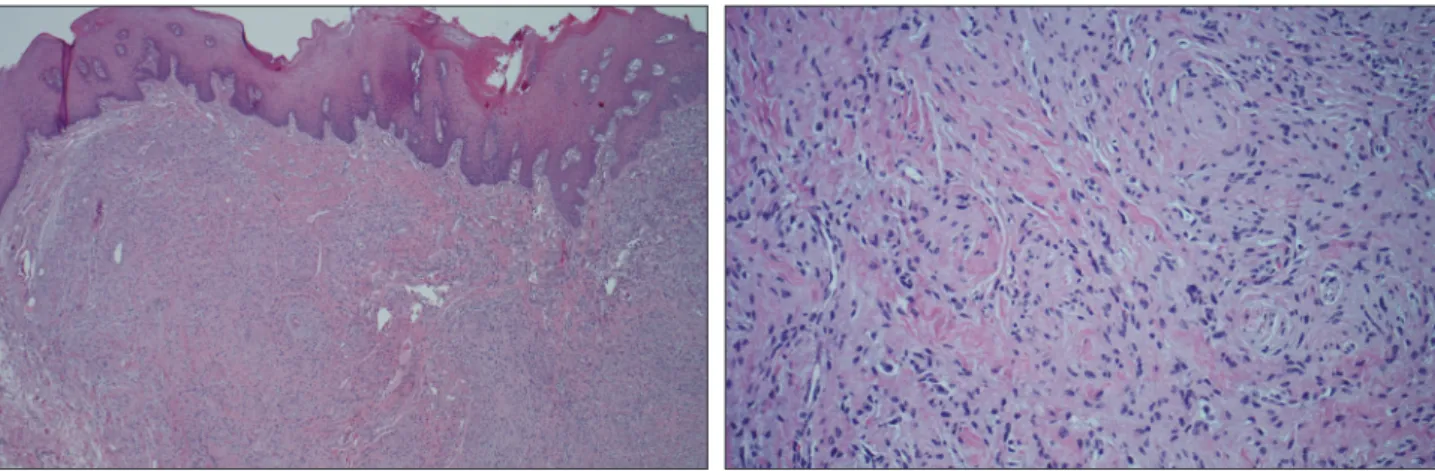 Fig. 1. Preoperative appearance of the lesion. An approximately  1 × 0.8 cm sized, firm, non-tender, nodule in her left inner mucosal  area on the lower lip with overlying mucosa.