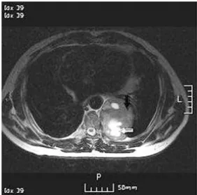 Fig. 3. Specimen is three ribs with attached round  mass. The 9x8x5cm sized mass is located in the internal surface of ribs
