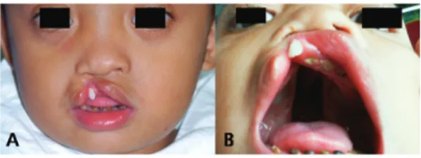 Figure 1. Preoperative view shows a wide cleft  gap  including alveolus,  bulging of  underlying  orbicularis oris muscle and deviated nose