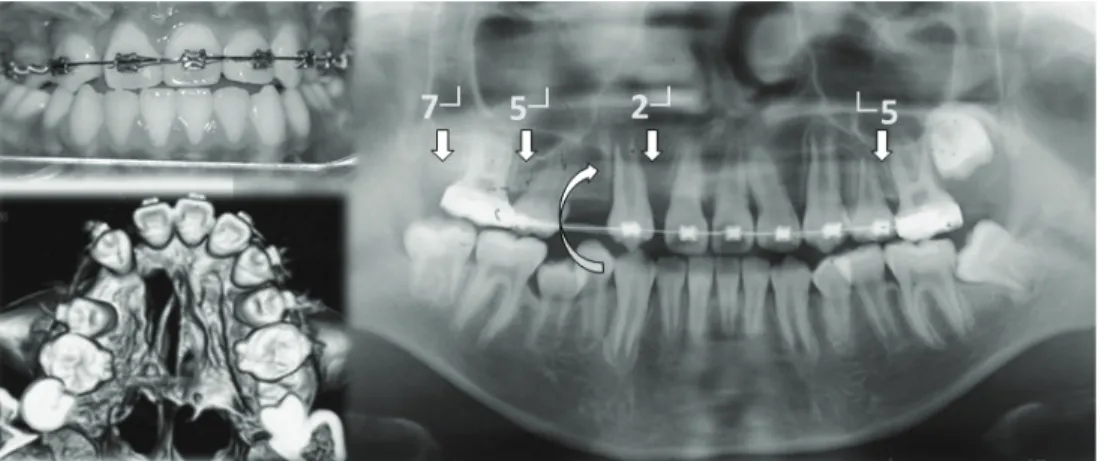 Figure 8. A case with multiple congenitally missing teeth: Maxillary dental arch has four missing  teeth: right lateral incisor, second premolar, second molar, and left second premolar.