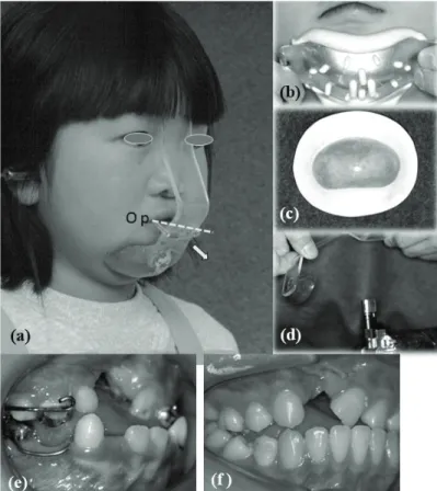 Figure 1. Maxillary protractor, our  designed maxillary protracting bow  appliance (MPBA, a): When we make an  MPBA,  first  we  take  an  impression of the mental chin (b)  and make a chin pad from acrylic  (c)