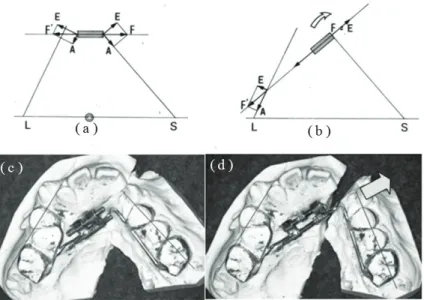 Figure 3. Jointed fan-type expander: The expanding force (F) is divided into two force elements: namely the expanding element (E) and the anchorage element (A)
