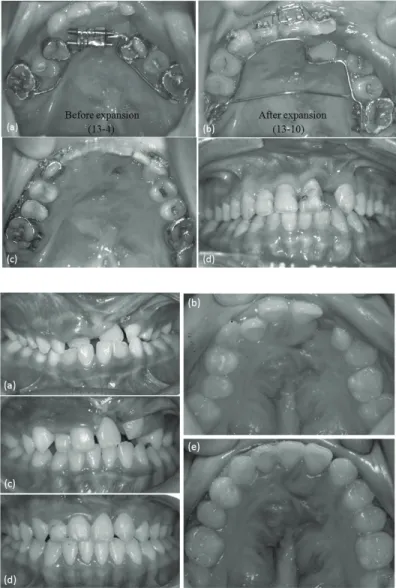 Figure 5. Maxillary expansion by Jointed  fan-type expander: Almost all the teeth  exhibit crossbite, and the small segment  shows severe collapse at 13 years old