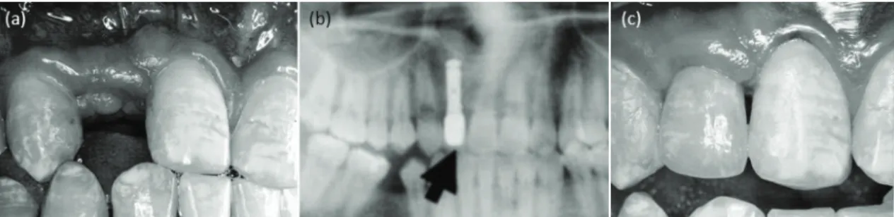 Figure  7.  Secondary  bone  grafting  provides  bony  support  for  subsequent  placement  of  the  osseo-integrated  dental  implant