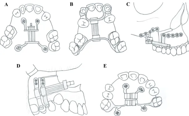 Figure  1.  다양한  구강내  신장기  모식도,  A.  palatal  bone-borne  distractor,  B.  Palatal  tooth-borne  distractor, C