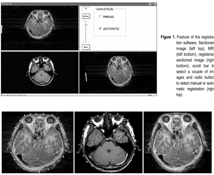 Figure 2. Manual registration. Both sectioned image and MRI with the corresponding dots pointed on the skins (left two); registered  sectioned image (right)
