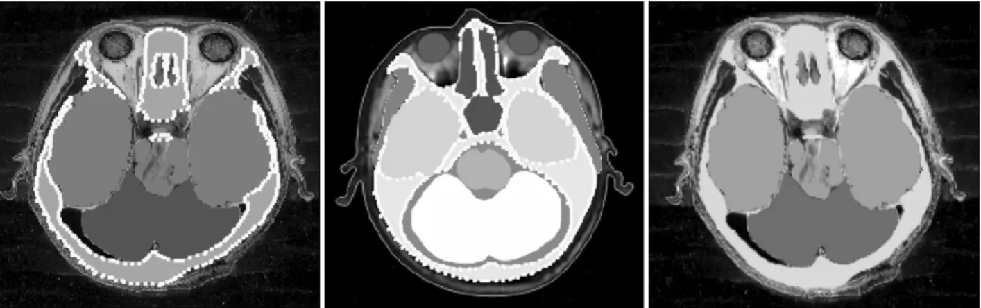 Figure 3. Automatic registration based on bone. Segmented sectioned image (left) and segmented MRI (center) with dots pointed on  the skull; registered segmented sectioned image (right)