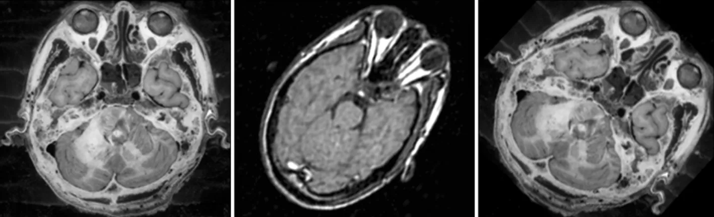 Figure 6. Inadequate registration due to rigid registration algorithm. Sectioned image (left), MRI (center), registered sectioned image  (right) 다는 것을 이 연구에서 깨달았다