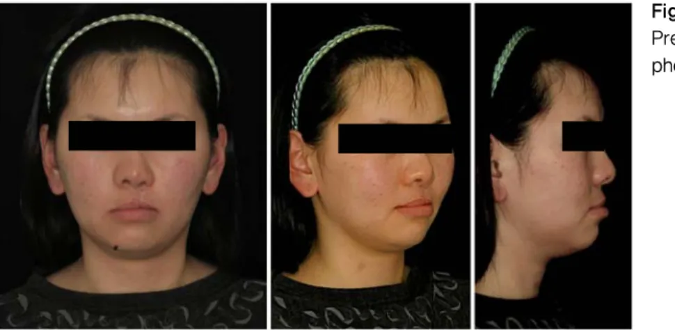 Figure 2.  Pre-treatment  vertical proportion  of the face. 하악의  고경상실과  그에  따른  mandibular  over closure 때문이었다