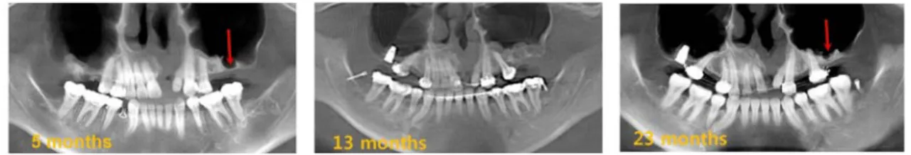 Figure 8. Panograms before artificial bone graft, immediately after, and 10 months later are shown