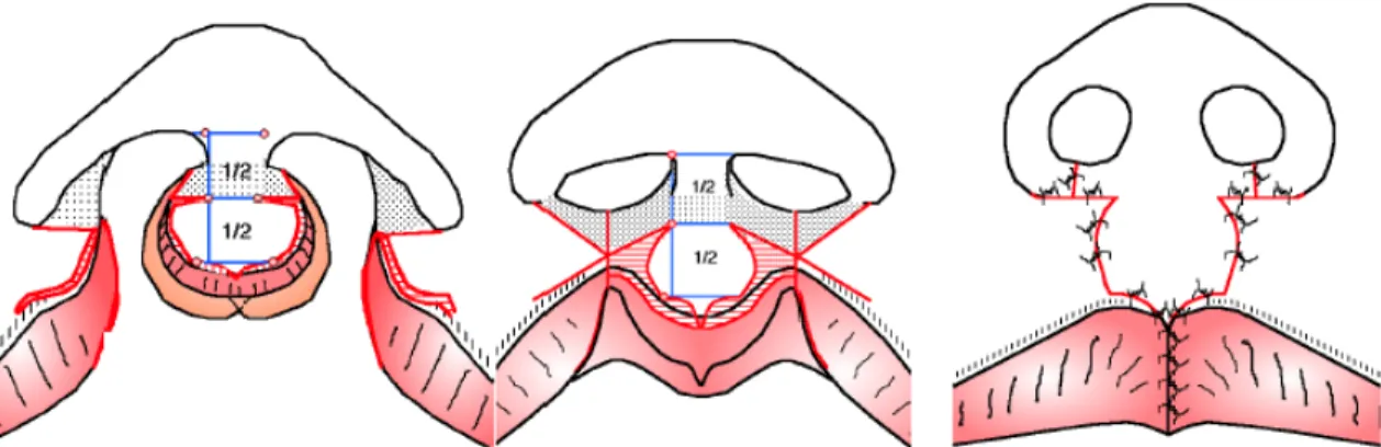 Figure 8. Schematic designs in bilateral complete (left) and incomplete (middle) labiomaxillary  clefts, and final outcome (right).