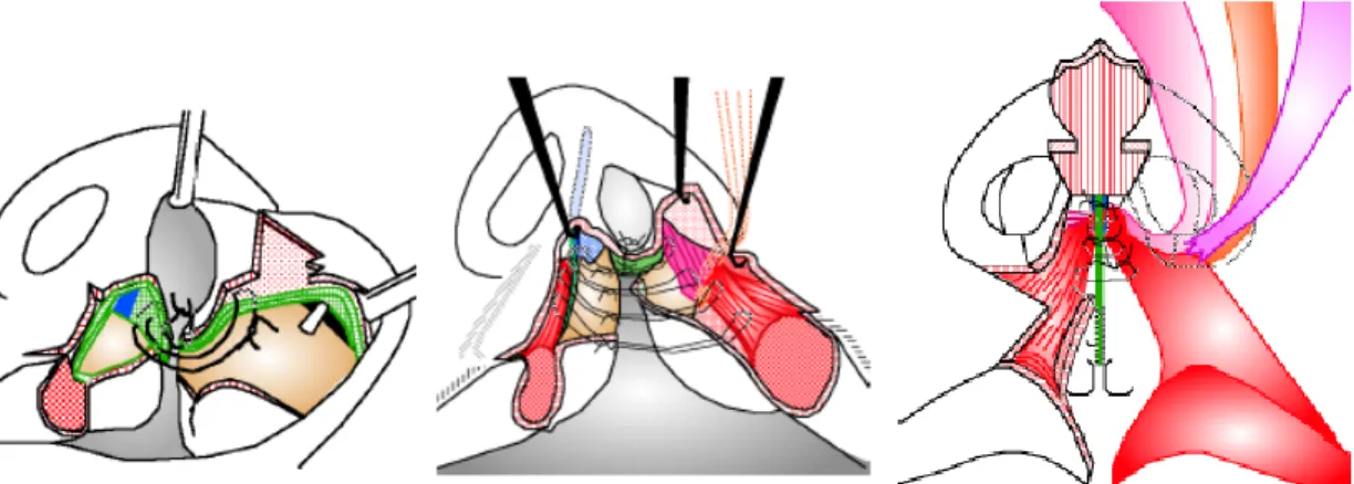 Figure 6. Schematic drawings of insertion of oblique heads of orbicularis oris muscle into the  region of the anterior nasal spine for nasal floor reconstruction.