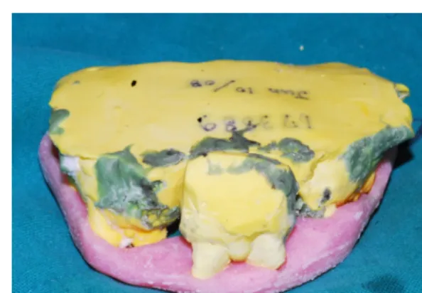 Figure 2. Model surgery and surgical template  fabrication. 