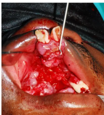 Figure 3. Premxilla was sectioned and     Figure 4. Bone from iliac crest was packed into bony gap.