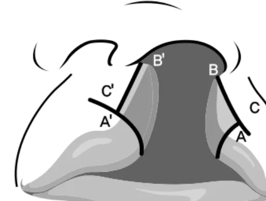 Figure  1.  Schematic  design  of  quadrilateral  flap. A: Peak of Cupid’s bow (lateral aspect of  cleft  side),  A' : Peak  of  Cupid’s  bow  (medial  aspect of cleft side), B: Floor of nostril (lateral  aspect of cleft side), B' : Floor of nostril (media