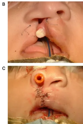 Figure 2. A patient of unilateral complete  cleft lip on right side (1 year-old female,  who  was  treated  by  Wang’s  modified  quadrilateral flap technique.), A : Design  of  quadrilateral  flap,  B  :  Pre‐operative  view shows wide cleft including alv