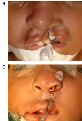 Figure  3.  A  patient  of  unilateral  incomplete cleft lip on left side (6 year-  old female, who was treated by Wang’s  modified quadrilateral flap technique.), A  :  Design  of  quadrilateral  flap,  B  :  Pre‐