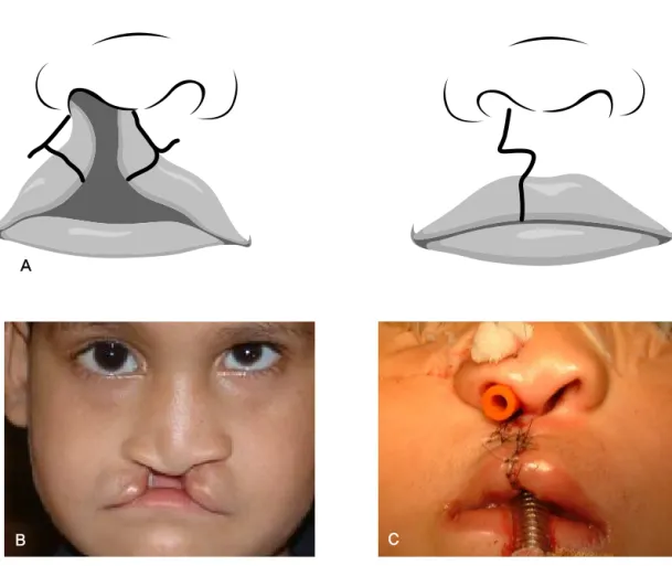 Figure 4. A patient of unilateral incomplete cleft lip on right side (2 year-old male,  who  was  treated  by  Wang’s  modified  quadrilateral  flap  technique.),  A : Design  of  quadrilateral flap, B : Pre‐operative view shows wide cleft including alveol
