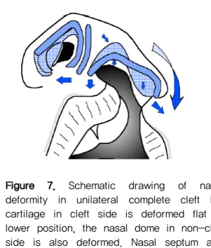 Figure  7.  Schematic  drawing  of  nasal  deformity  in  unilateral  complete  cleft  lip; 