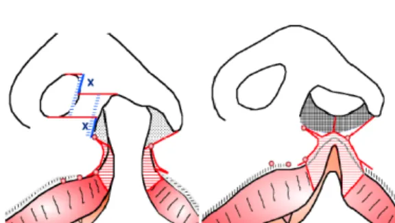 Figure 9. Schematic drawings of mucocutaneous  abnormalities  in  unilateral  cleft  lip,  1-1’; 