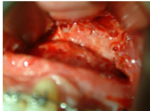 Figure 5. Superimposition of preoperative,  completion  of  DO  and   postoperative  cephalogram in case 1 patient.