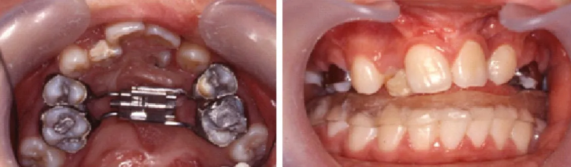 Figure 6. TPA and fixed appliance were applied, the maxillary left lateral incisal was  tracted labially using lingual button and elastomeric thread.
