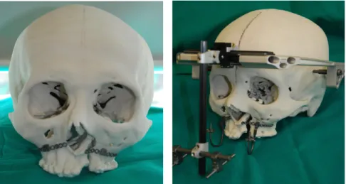 Figure 5. Preoperative adaptation of the distracter on the RP model.
