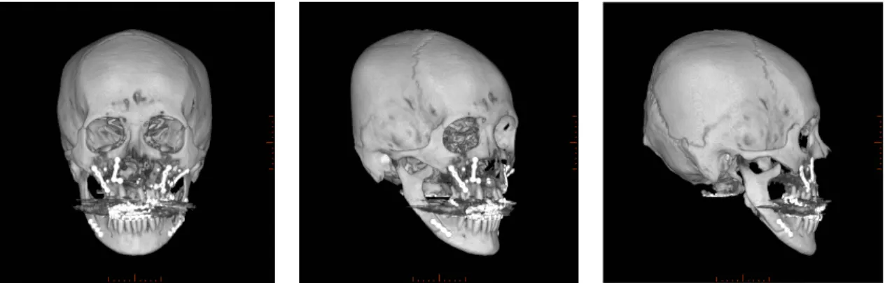 Figure 16. Postoperative 3D CT views after the orthognathic surgery.