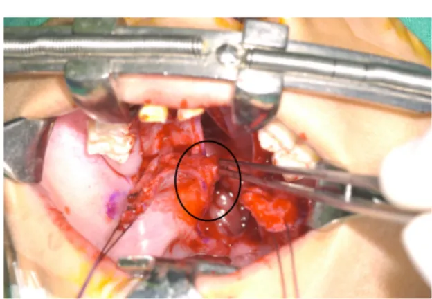 Figure  5.  Vomer  flap  allows  closure  of  the  nasal layer mucosa in a bilateral cleft of the 
