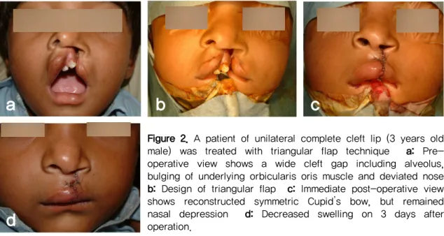 Figure 2. A patient of unilateral complete cleft lip (3 years old  male)  was  treated  with  triangular  flap  technique    a:  Pre-  operative  view  shows  a  wide  cleft  gap  including  alveolus,  bulging of underlying orbicularis oris muscle and devi