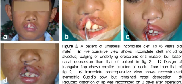 Figure 3. A patient of unilateral incomplete cleft lip (6 years old  male)    a:  Pre-operative  view  shows  incomplete  cleft  including  alveolus, bulging of underlying orbicularis oris muscle, but lesser  nasal  depression  than  that  of  patient  in 
