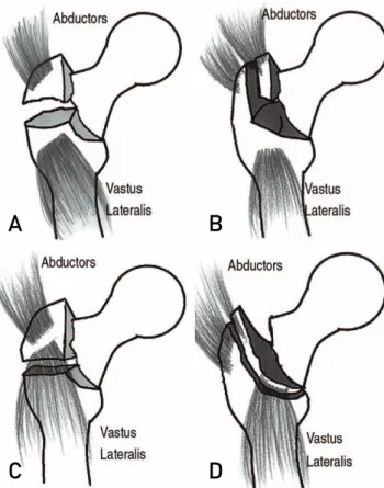 Table 1. Classification of Greater Trochanter Fractures and Fixation Methods according to Types