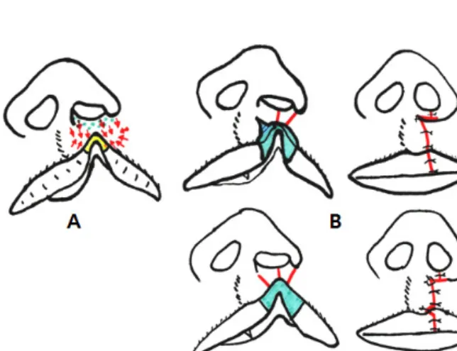 Figure 2. The original design of Delaire’s technique for unilateral incomplete cleft lip