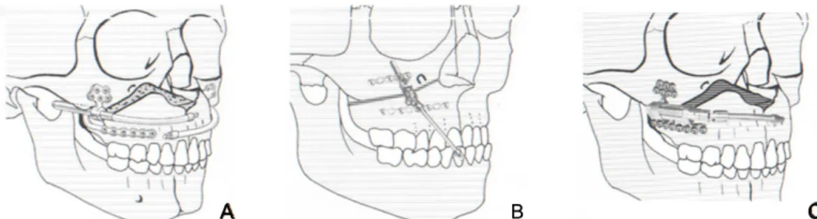 Figure  2.  외고정  장치,  A.  Leipzing  Retention  plate  in  situ,  B.  Square  rods  bent  into  the  desired form, C