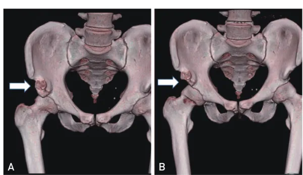 Table 1. Type of the Anterior Inferior Iliac Spines (AIIS)