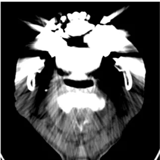 Fig. 3. Computed tomography (CT) artifact due to a dental prosthesis: artifacts in a CT scan can cause significant errors in proton therapy dose calculation.