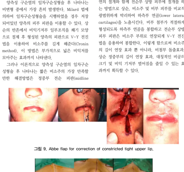 그림 9. Abbe flap for correction of constricted tight upper lip.