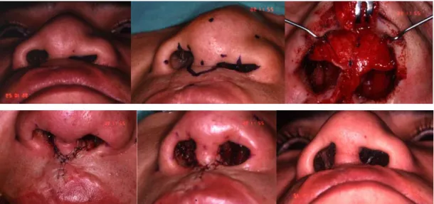 그림 11. Midline prolabial flap for columellar lengthening.