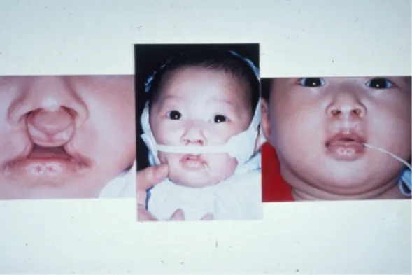 그림 1. Lateral pressure from the external elastic band induces to retract of the premaxilla  with  external  elastic  band