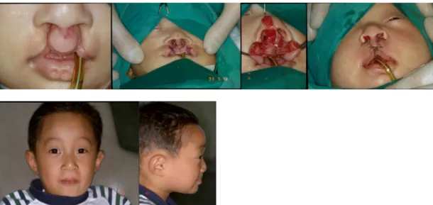 그림 4. Milard repair with banked fork flaps. Dissection and realignment of the orbicularis  oris muscle in bilateral cleft lip repair is very important