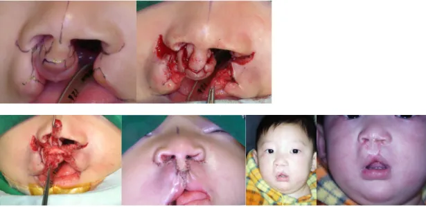 그림 5. Milard repair for correction of bilateral cleft lip. 
